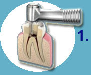 Cómo se hace una endodoncia - Clínica Dental Díez - tu dentista de confianza en Madrid Legazpi