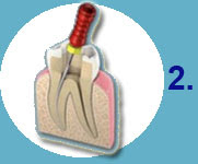 Cómo se hace una endodoncia - Clínica Dental Díez - tu dentista de confianza en Madrid Legazpi