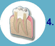 Cómo se hace una endodoncia - Clínica Dental Díez - tu dentista de confianza en Madrid Legazpi