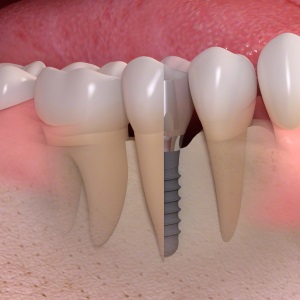 Implantes dentales en Clínica Dental Díez - tu dentista de confianza en Madrid Legazpi