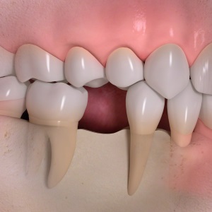 Implantes dentales en Clínica Dental Díez - tu dentista de confianza en Madrid Legazpi