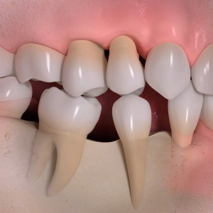 Implantes dentales en Clínica Dental Díez - tu dentista de confianza en Madrid Legazpi
