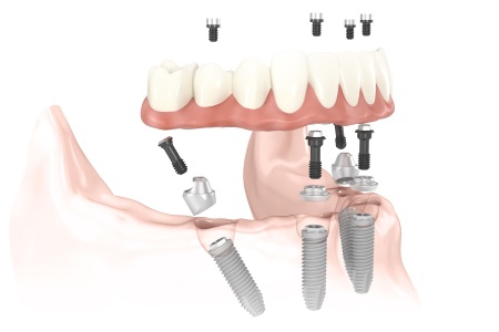 Técnica All on 4 Y All on 6 en Clínica Dental Díez - tu dentista de confianza en Madrid Legazpi