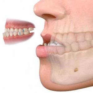 Ortognática en Madrid Legazpi Clínica Dental Díez